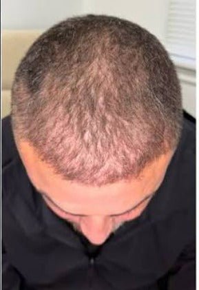 Before Scalp Coverage