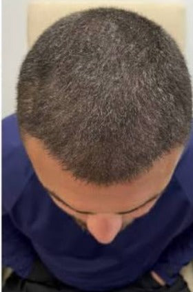 After Scalp Coverage