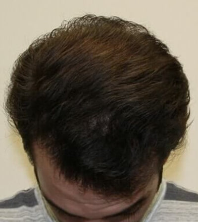 After Volume & Thickness